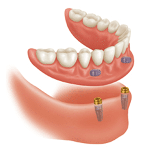 Snap On Dentures - Center for Implant & General Dentistry Lindale - Tyler TX