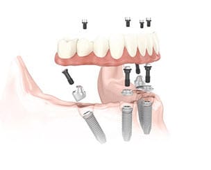 All on 4 Dental Implants Near Me - All on Four Dental Implants - Center for Dental Implants Serving Lindale - Tyler