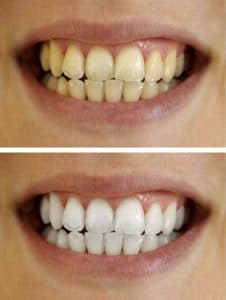 Best Teeth Whitening Lindale - Tyler TX - Center for Implants & General Dentistry