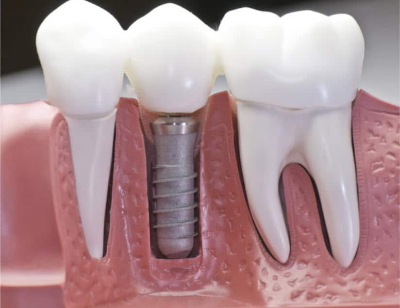 What are Dental Implants? Single, Multiple and Full Mouth Dental Implants - Center of Implant & General Dentistry Lindale - Tyler TX
