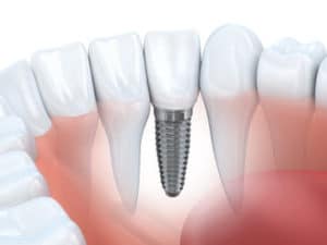 single dental-implant