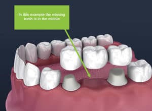 dental partial