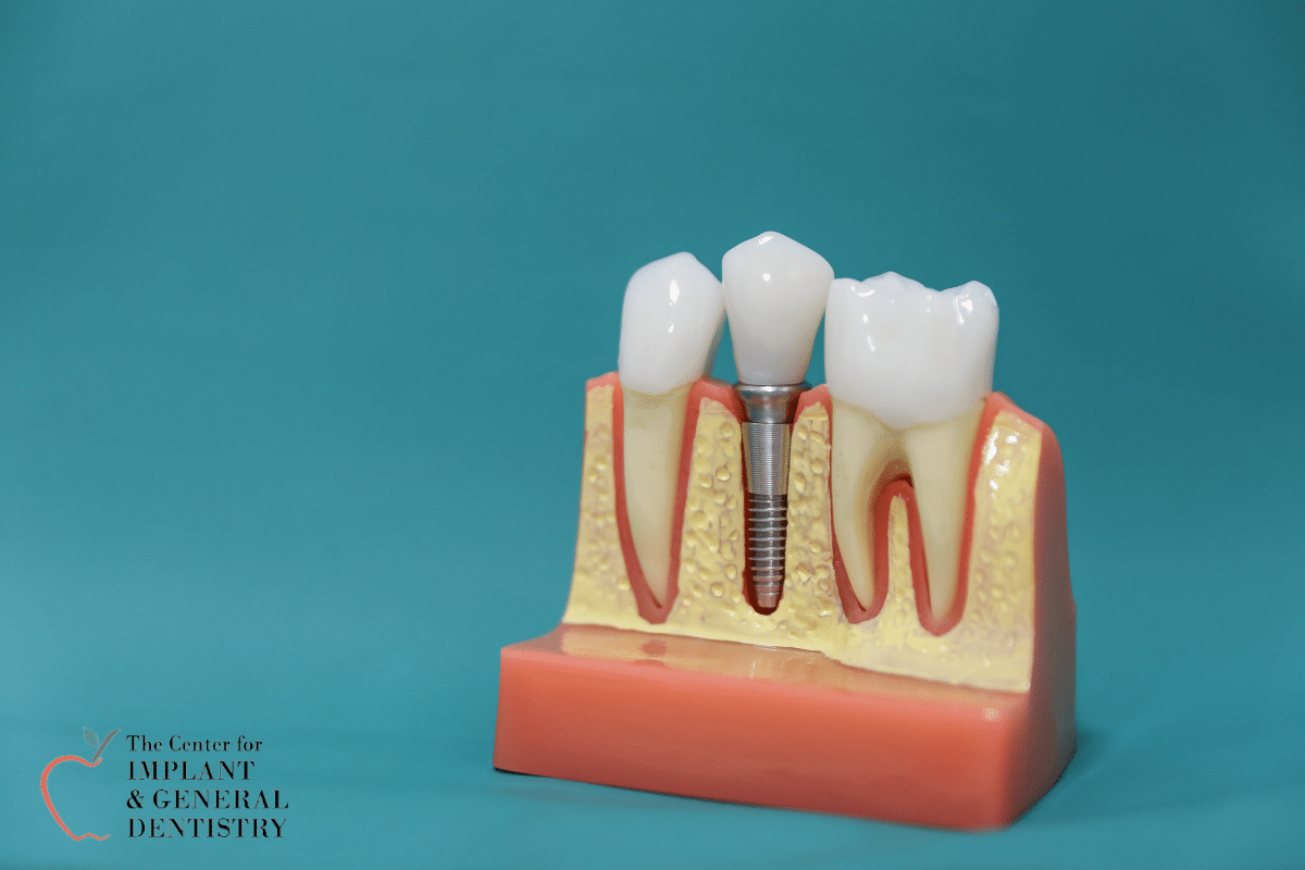4 Ways Dental Implants Improve Your Smile