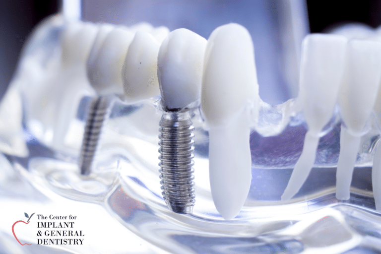 Revitalizing Your Smile: Exploring Teeth Restoration Options at The Center for Implant and General Dentistry