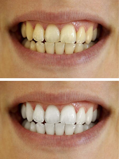 Bleaching Your Teeth Too Much Can Backfire
