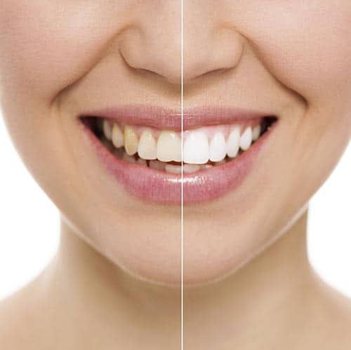 The Truth About Teeth Whitening: Myths, Facts, and Safe Practices