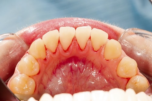 Times When You May Need to Redo a Root Canal