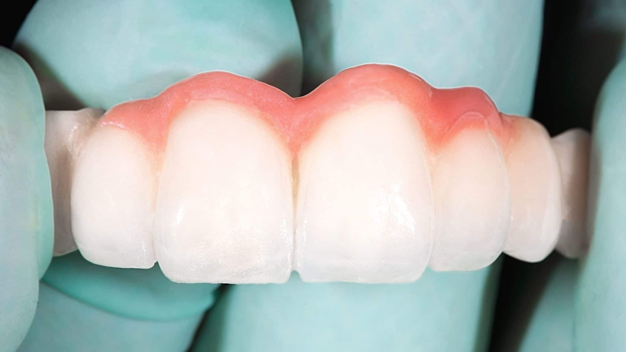 What is a Dental Bridge?