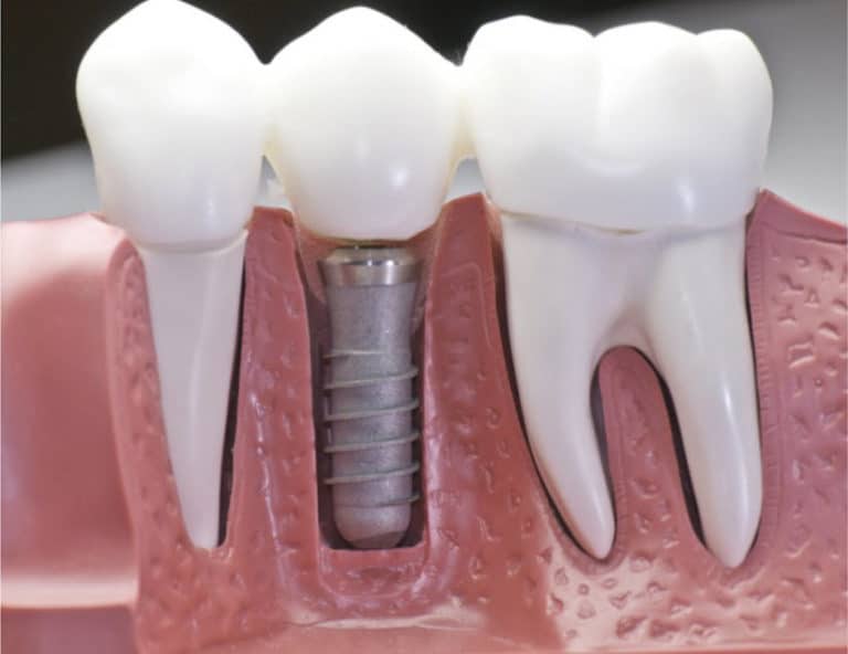 What are Dental Implants?