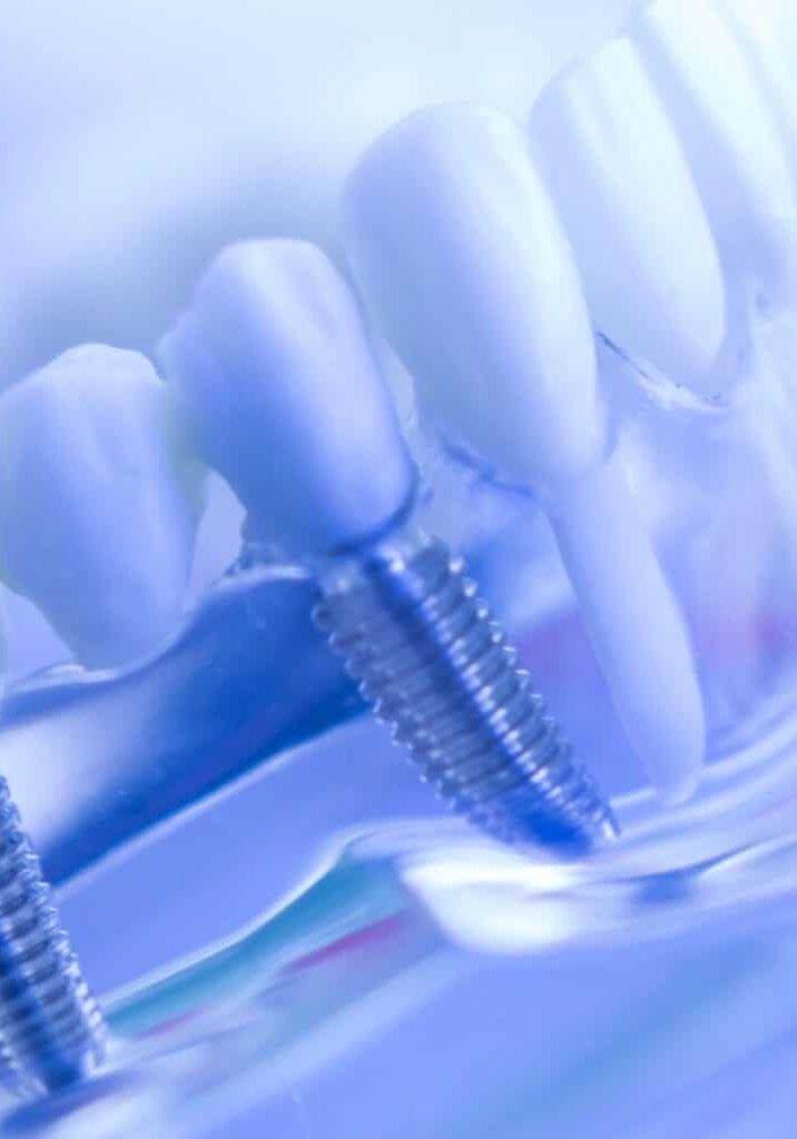 Dental Imaplants