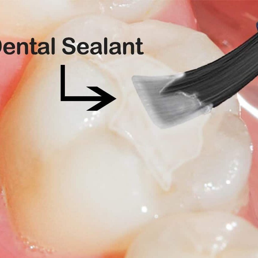 dental+sealant+applied+to+tooth+(molar)